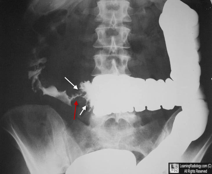 carcinoma colon